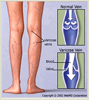 Abnormal Vein Valves