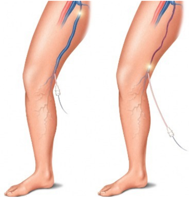 Endovenous Laser Treatment of Varicose Veins